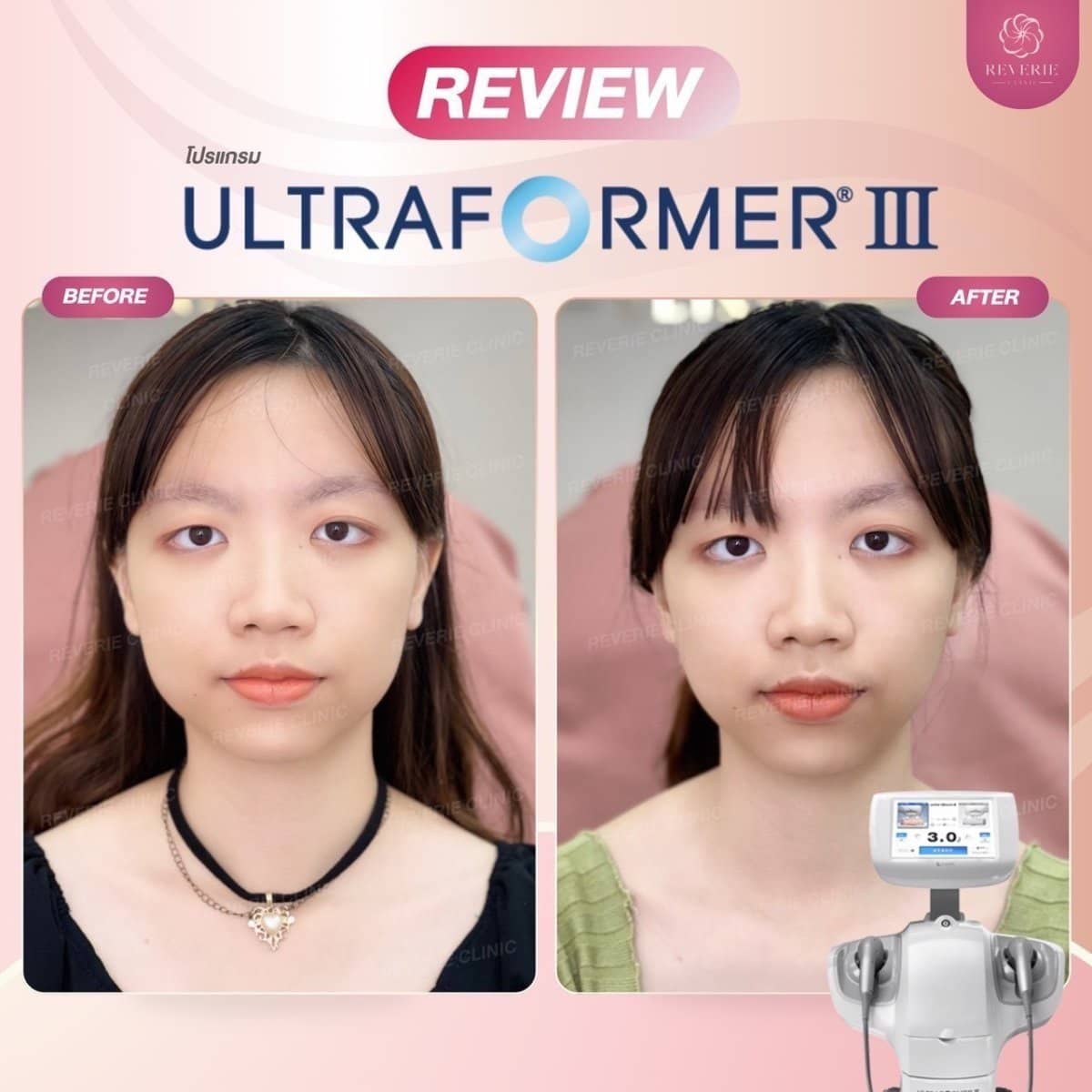 Case 19833 - nonsurgical facelift