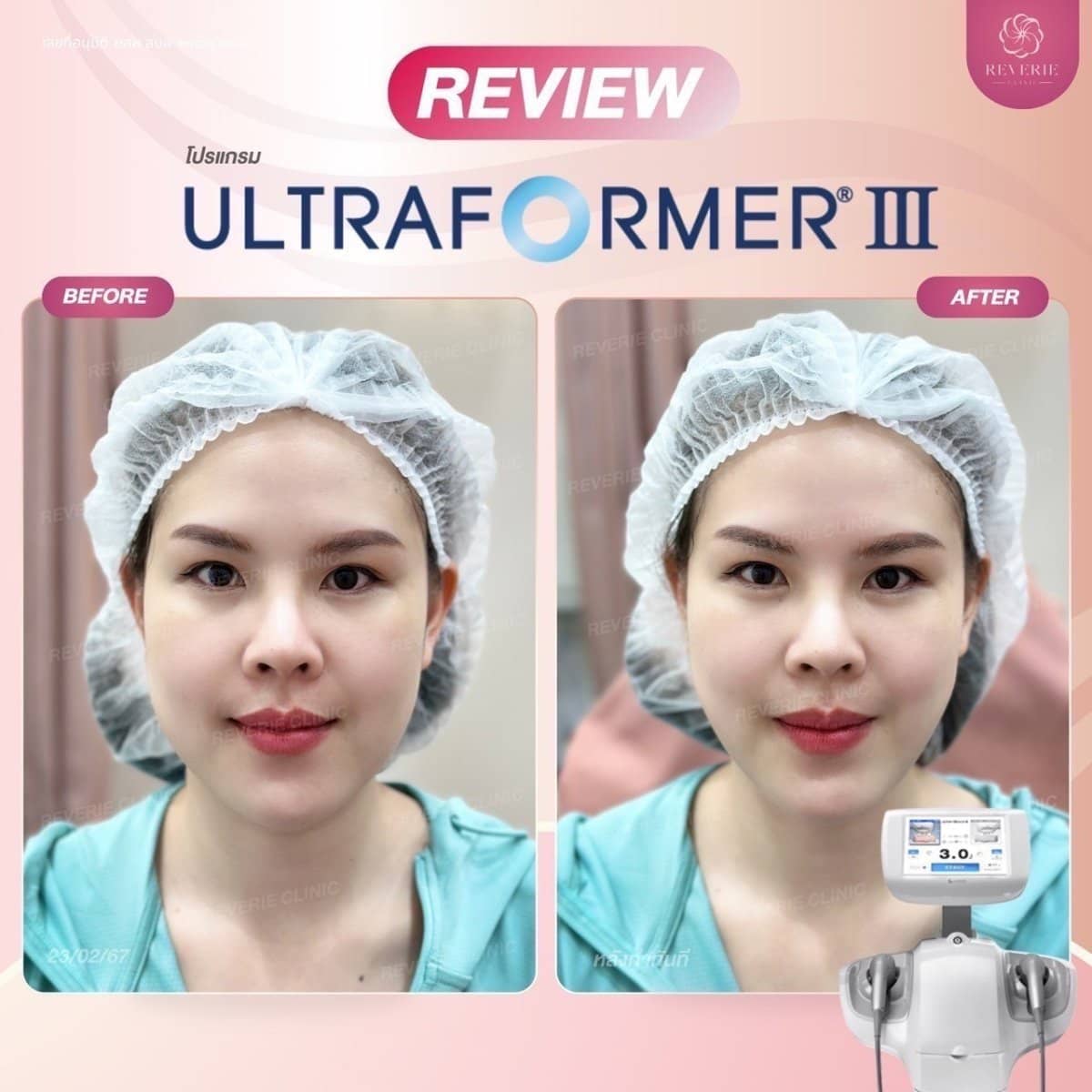 Case 19834 - nonsurgical facelift