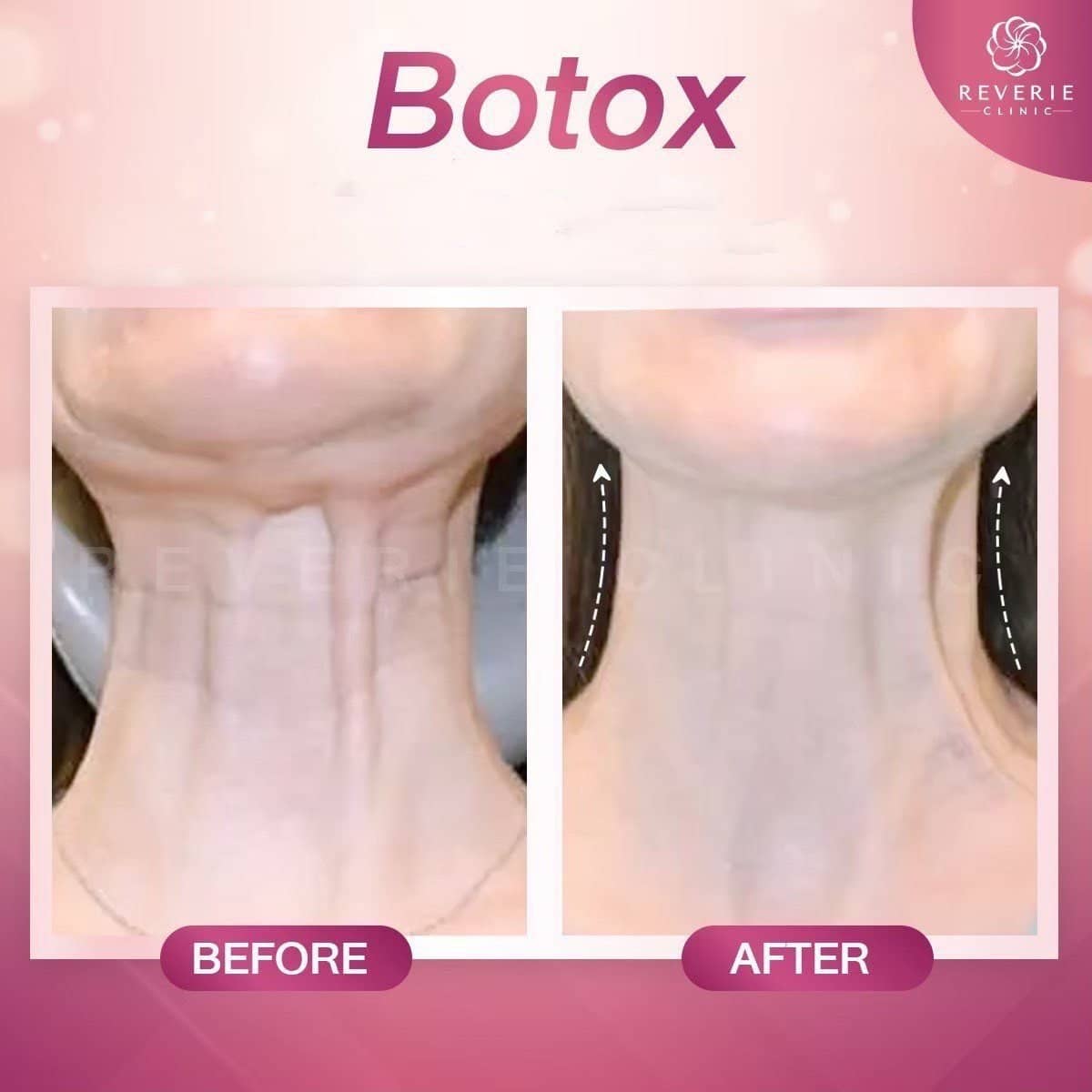 Case 19835 - Botox injections for neck rejuvenation