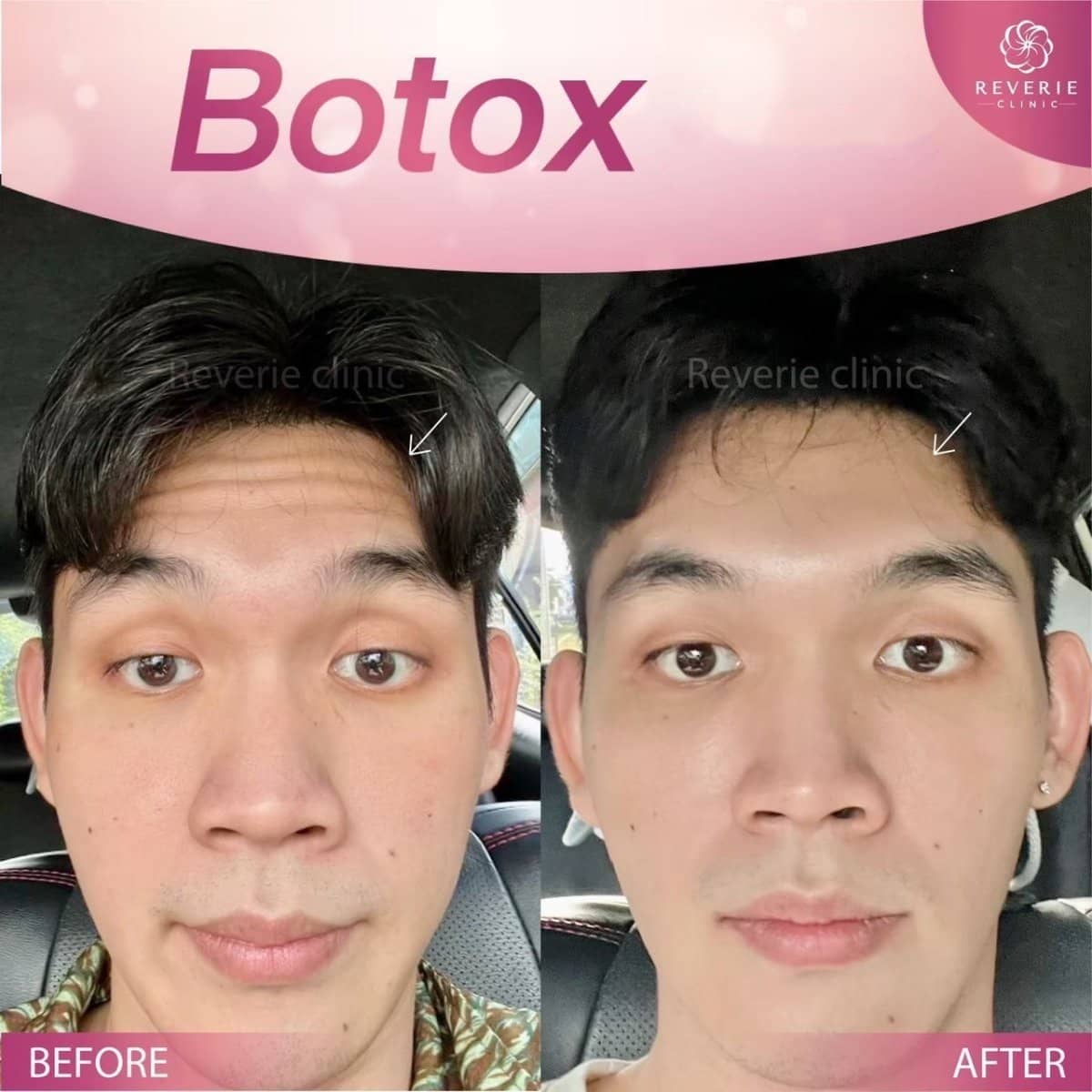 Case 19836 - Botox wrinkle treatment