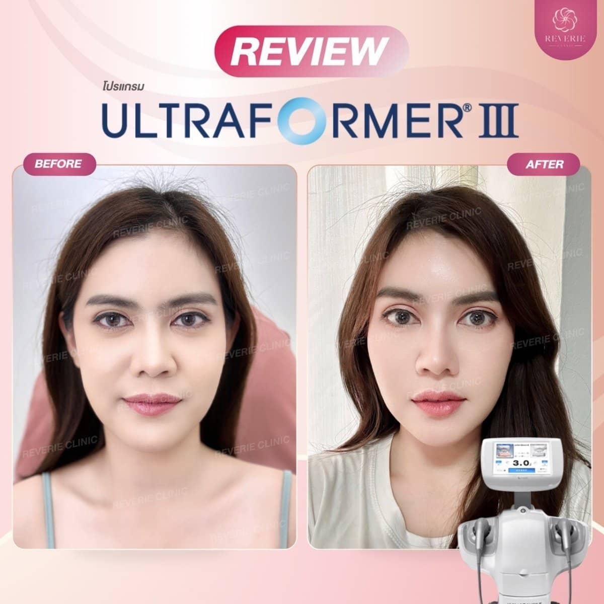 Case 19837 - nonsurgical facelift