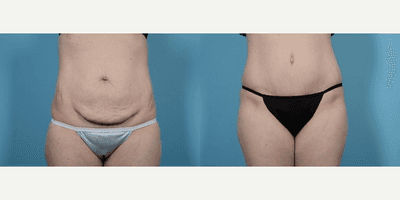 Case 1984 - Woman treated with Tummy Tuck
