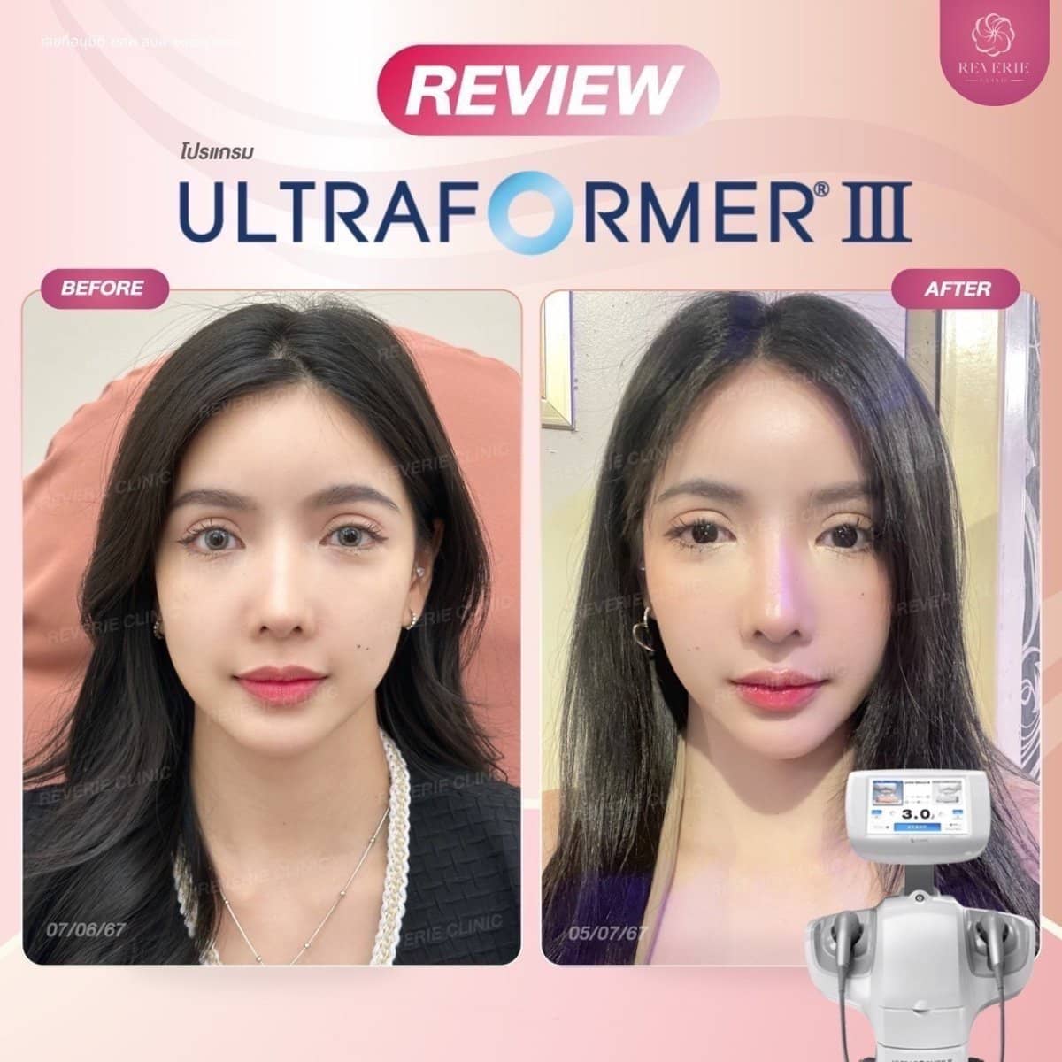 Case 19844 - nonsurgical facelift