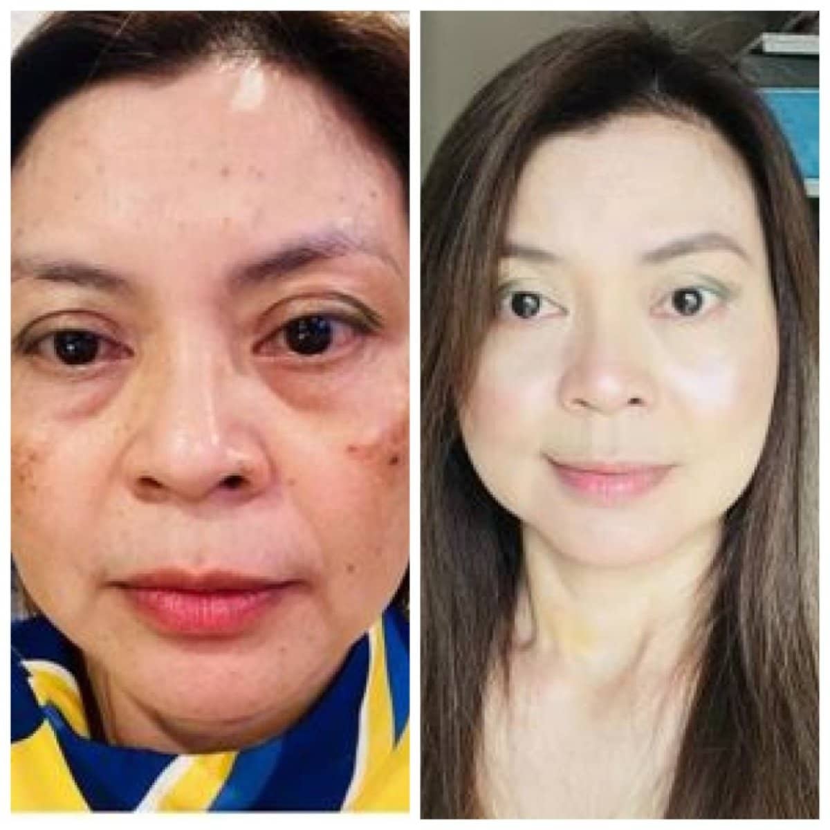 Case 19853 - stem cell therapy facial rejuvenation