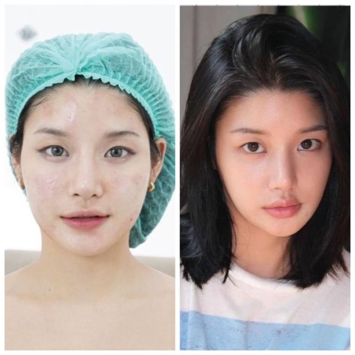 Case 19868 - stem cell therapy facial rejuvenation