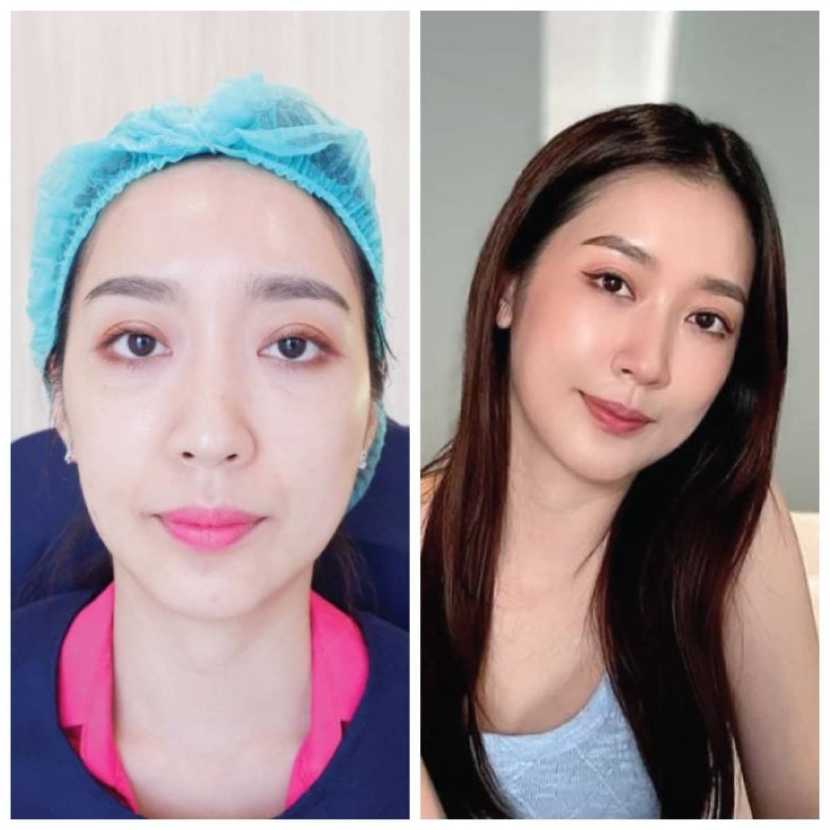 Case 19870 - stem cell therapy facial rejuvenation