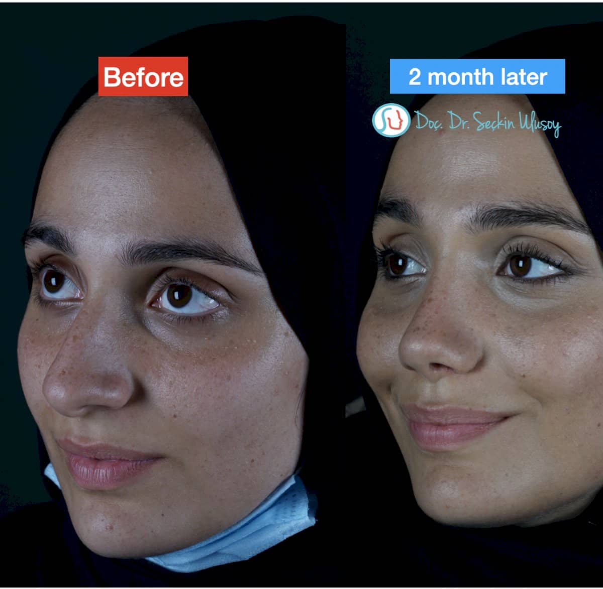 Case 19874 - rhinoplasty