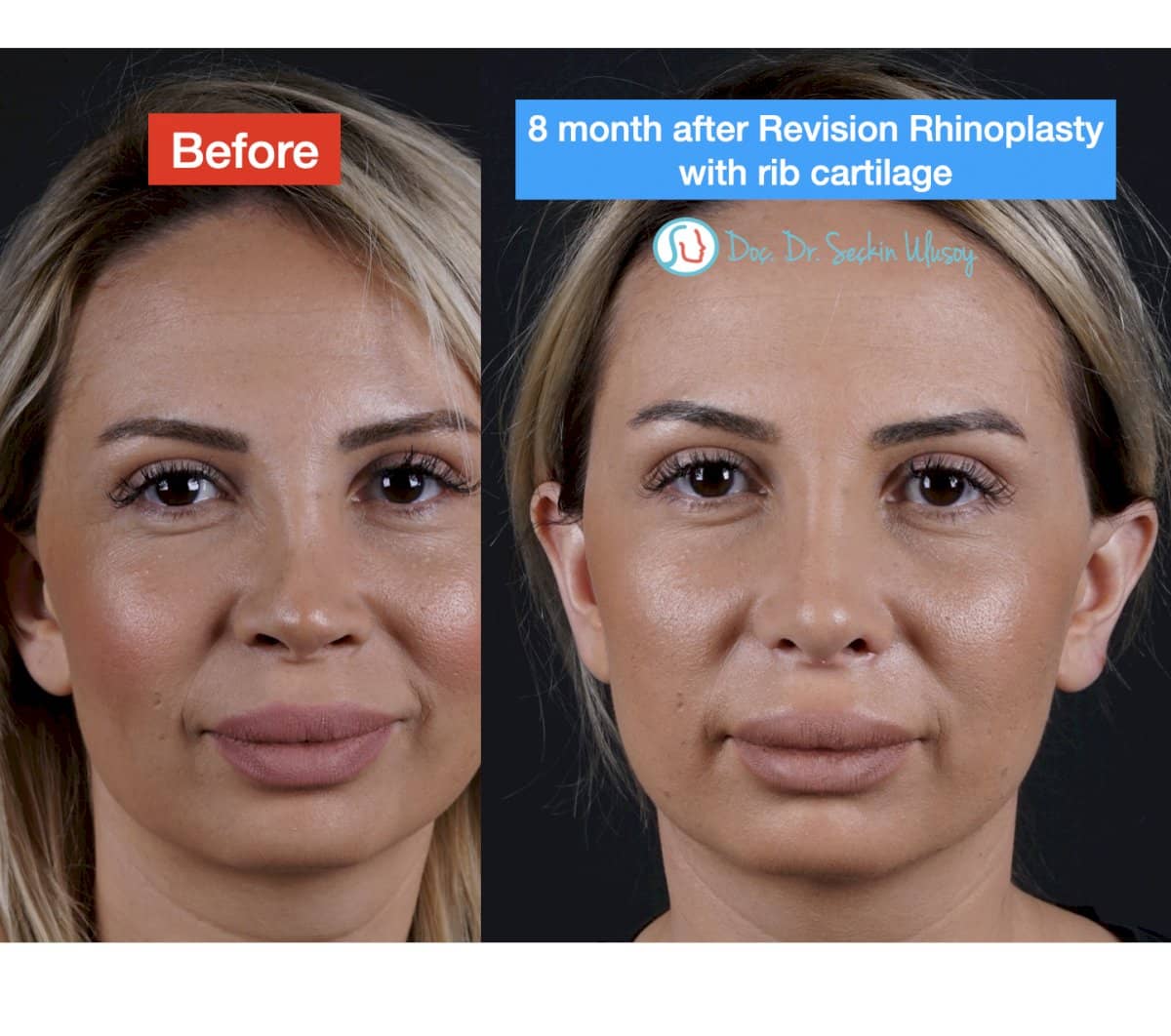 Case 19875 - revision rhinoplasty with rib cartilage