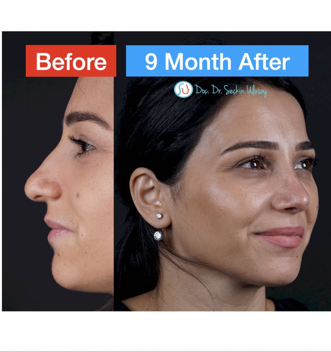 Case 19876 - rhinoplasty