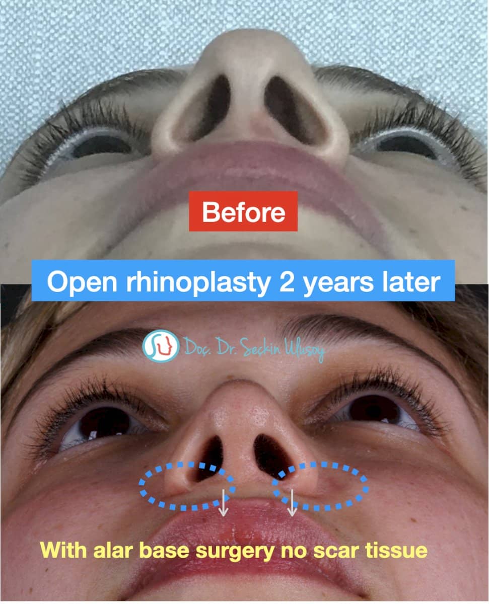 Case 19877 - open rhinoplasty