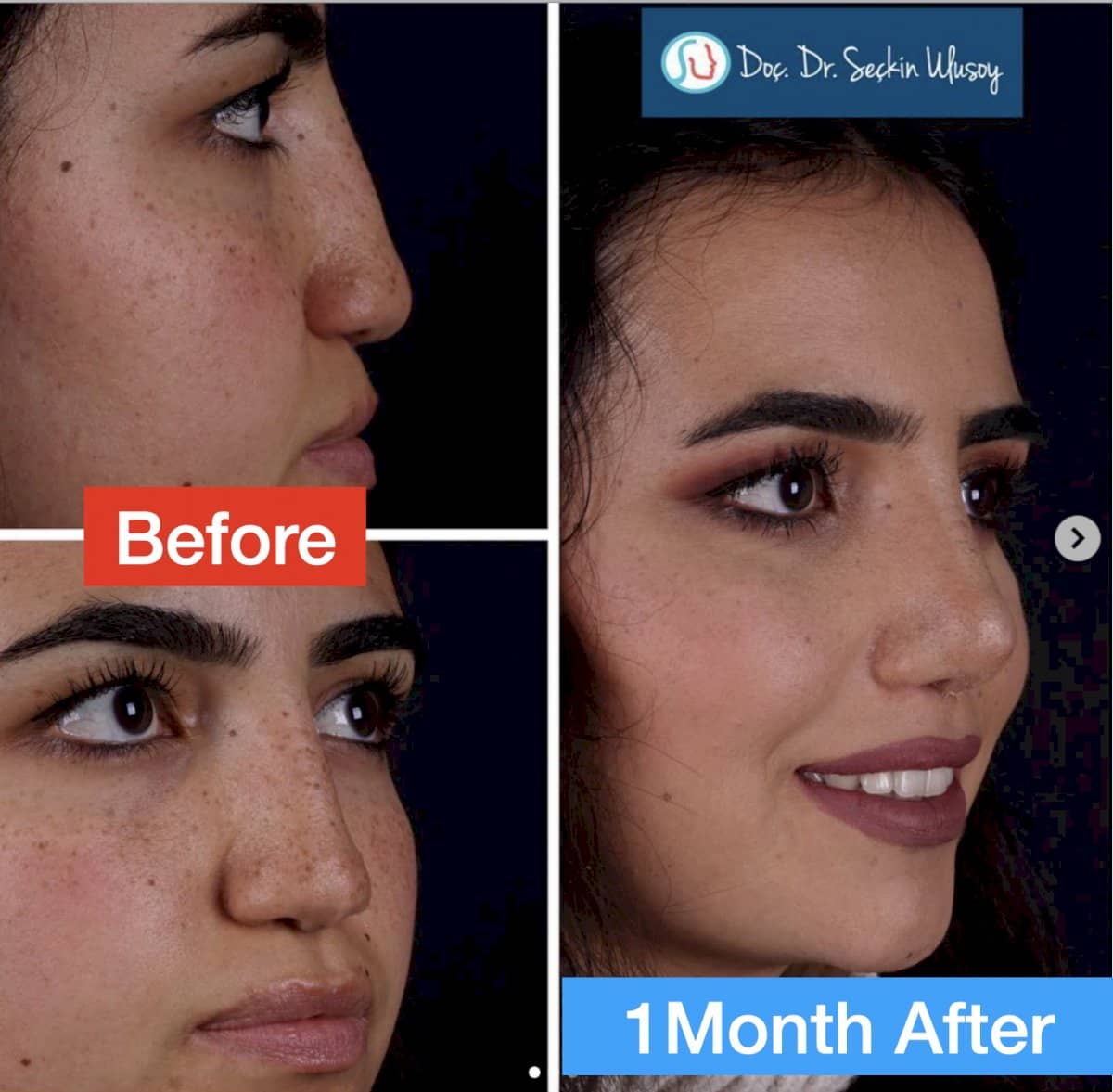 Case 19878 - rhinoplasty