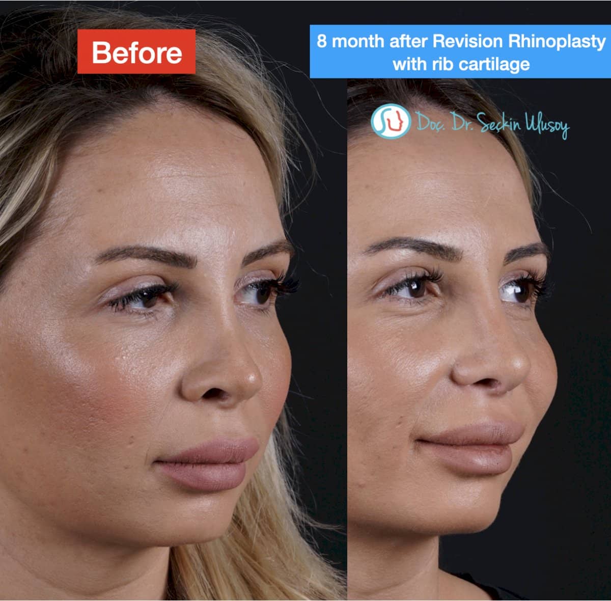 Case 19879 - revision rhinoplasty with rib cartilage