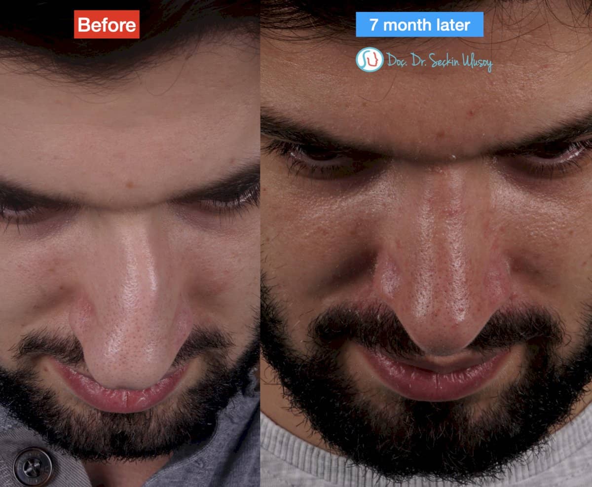 Case 19880 - rhinoplasty