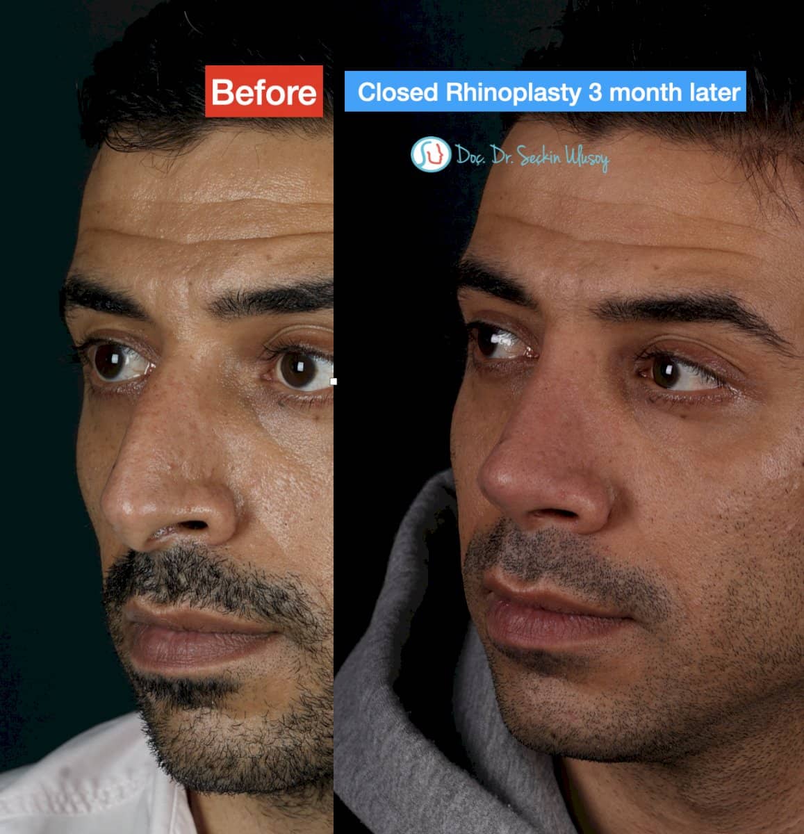 Case 19885 - closed rhinoplasty