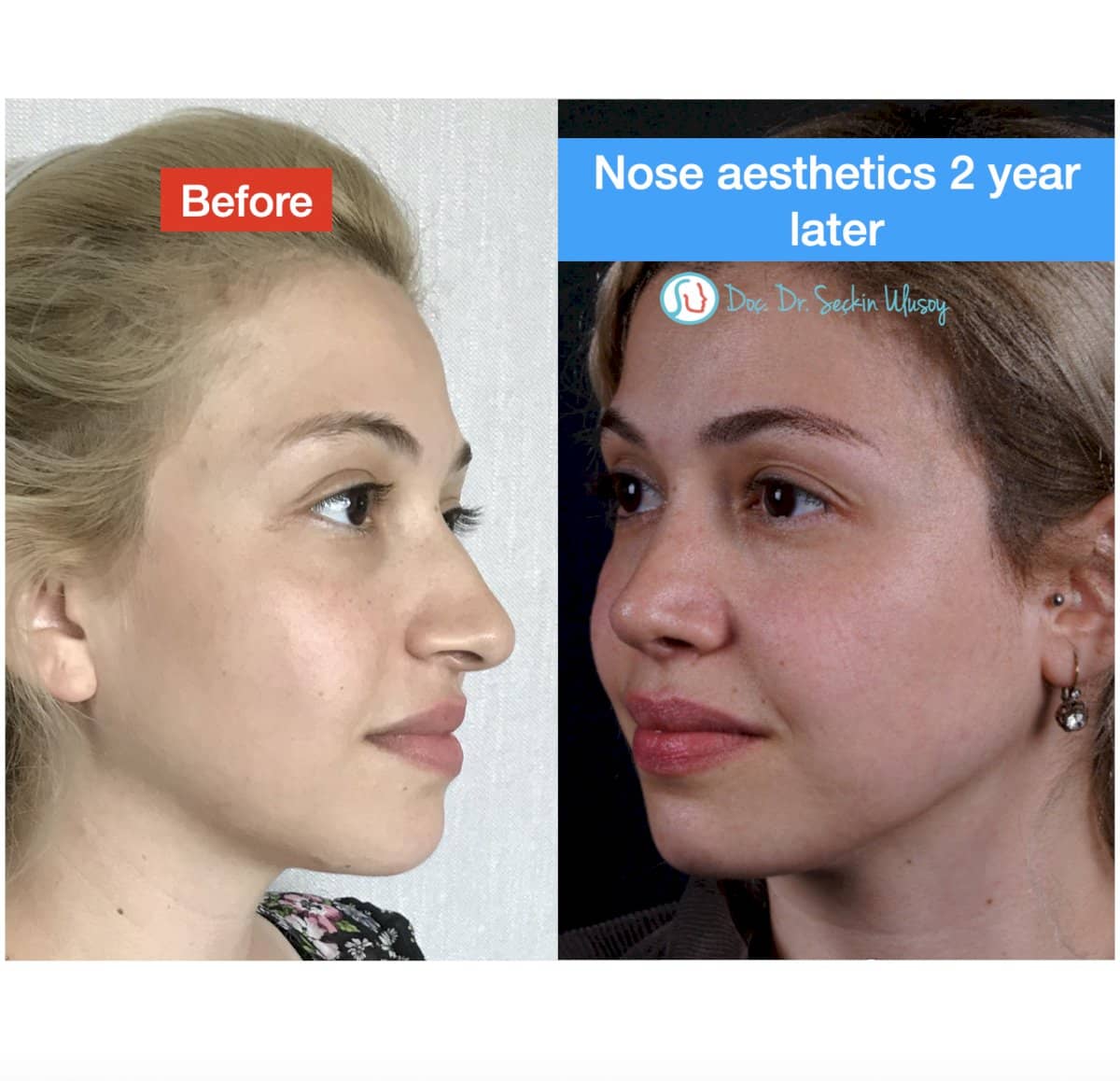 Case 19886 - rhinoplasty