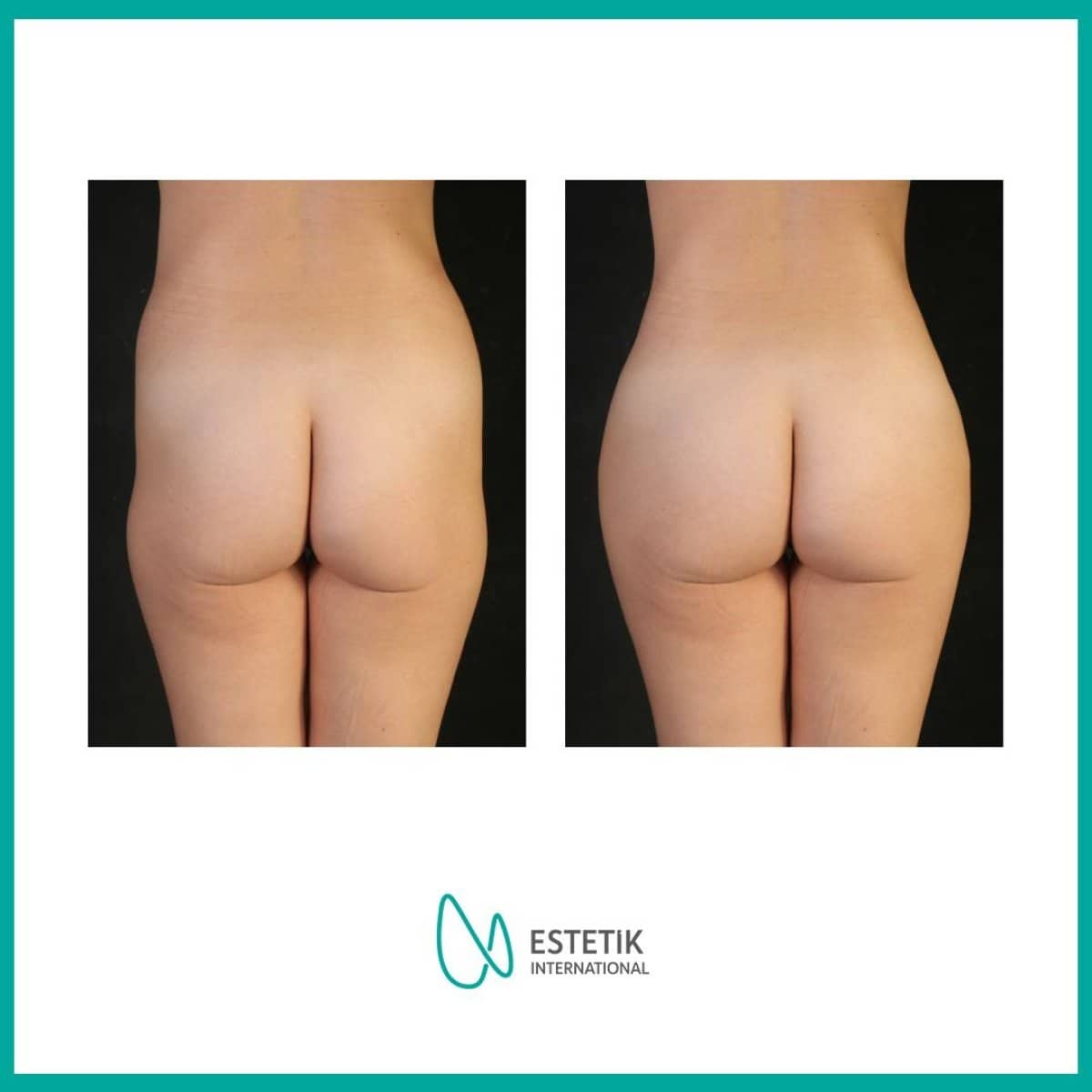 Case 19915 - butt implants