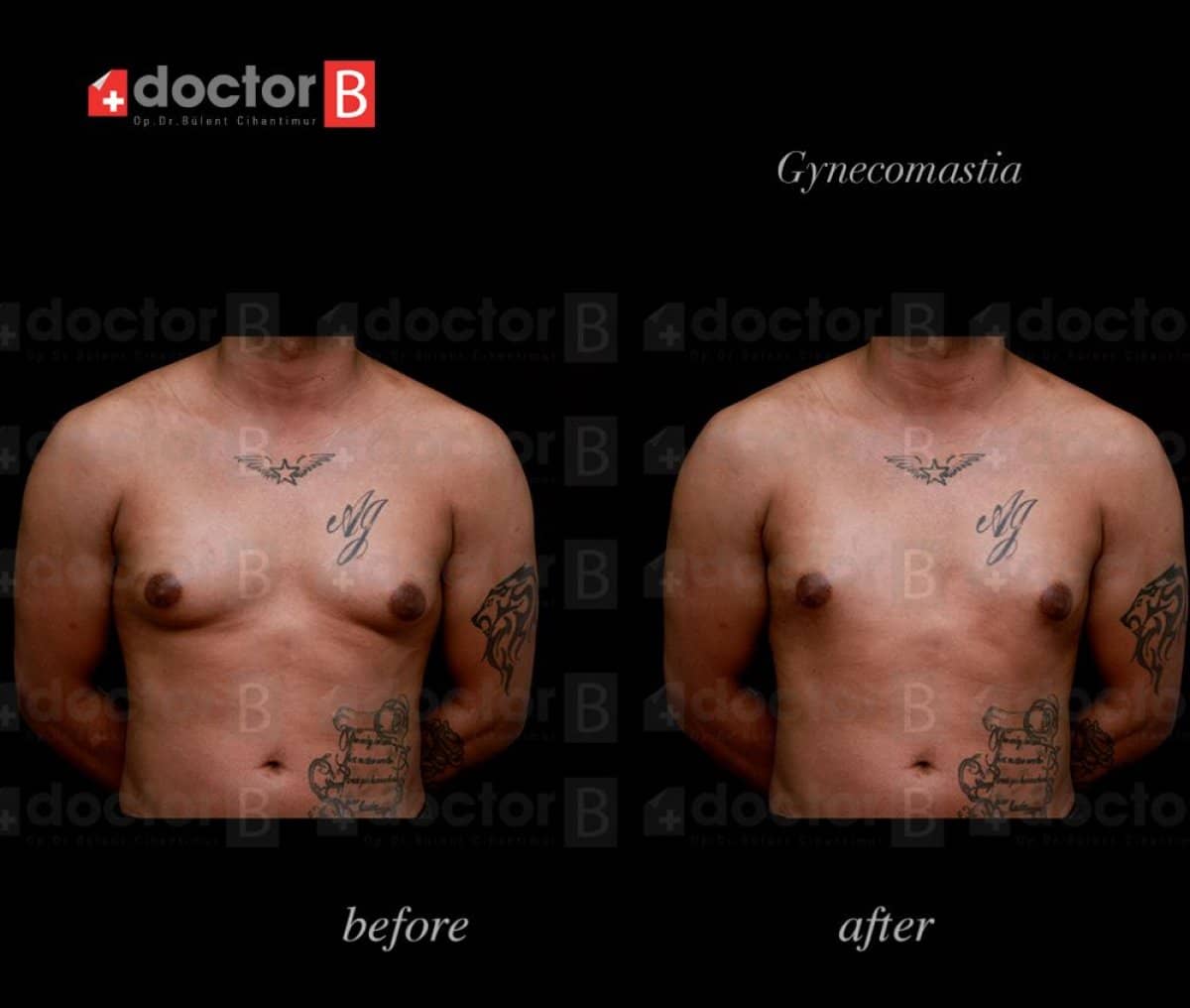 Case 19917 - gynecomastia surgery