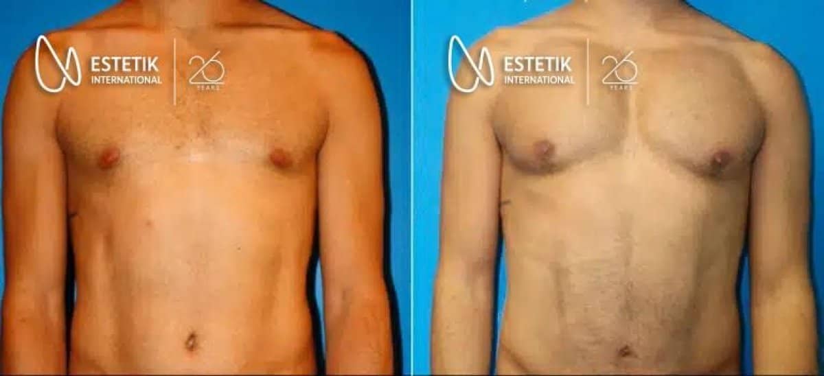 Case 19918 - pectoral implants