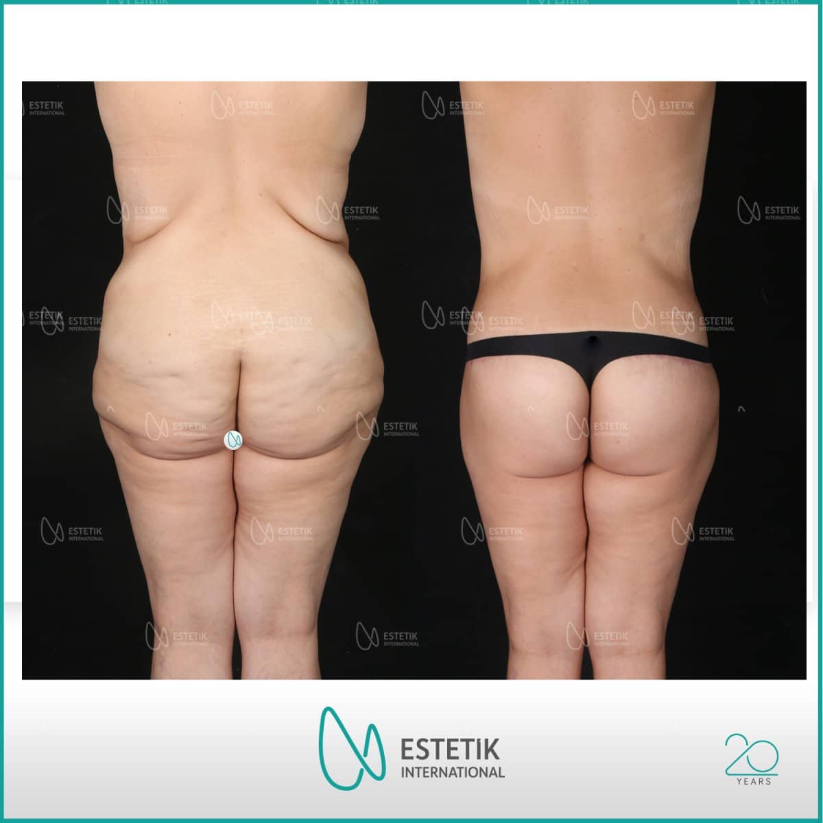Case 19919 - buttock lift