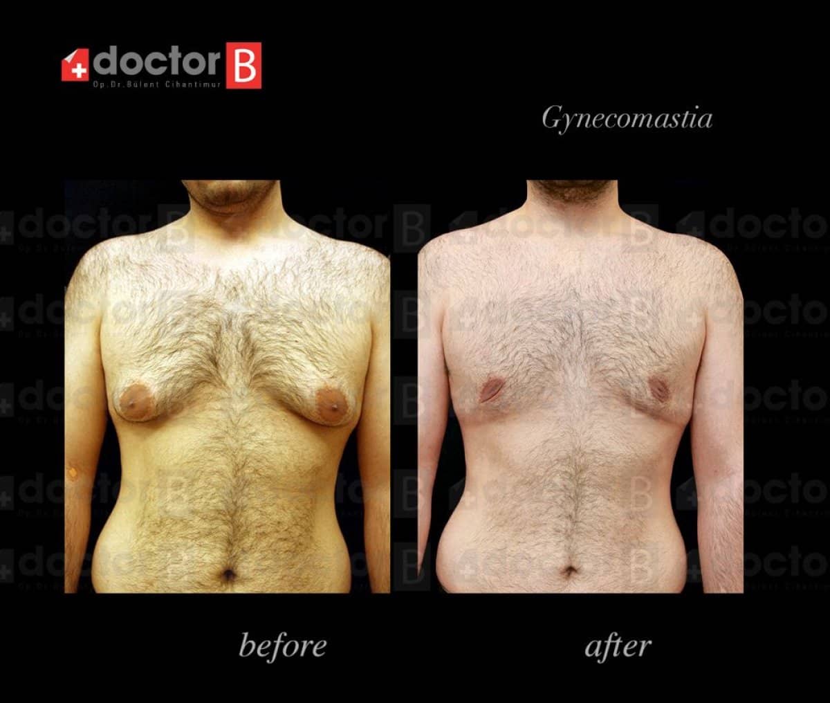 Case 19920 - gynecomastia surgery