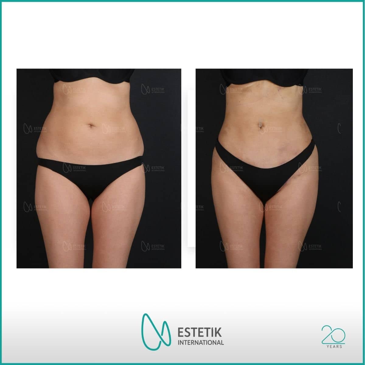 Case 19922 - tummy tuck and liposuction
