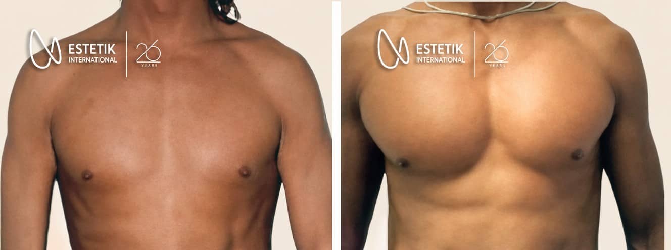 Case 19926 - pectoral implants