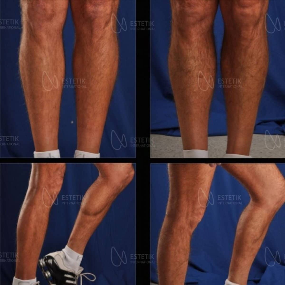 Case 19927 - calf implants