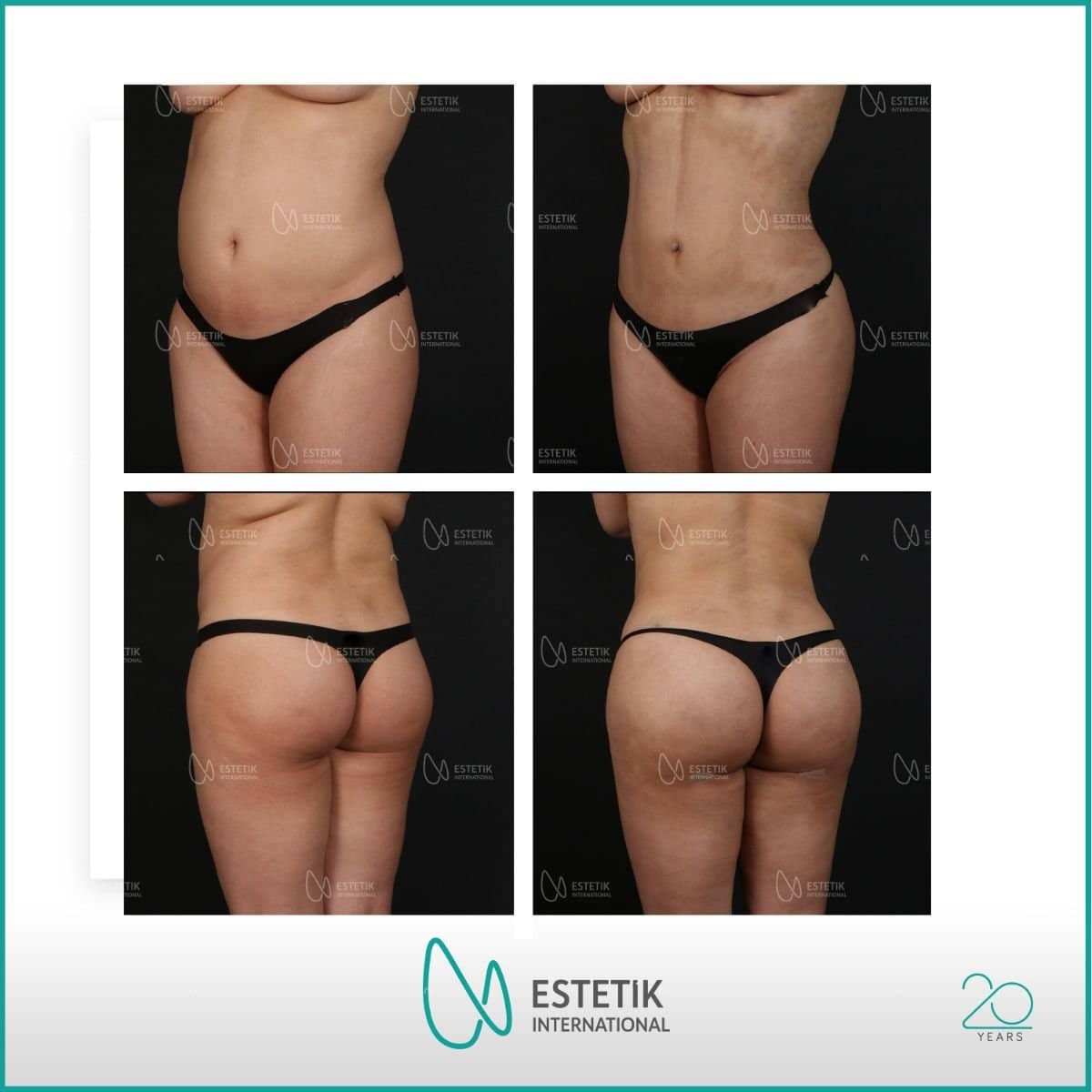 Case 19928 - liposuction
