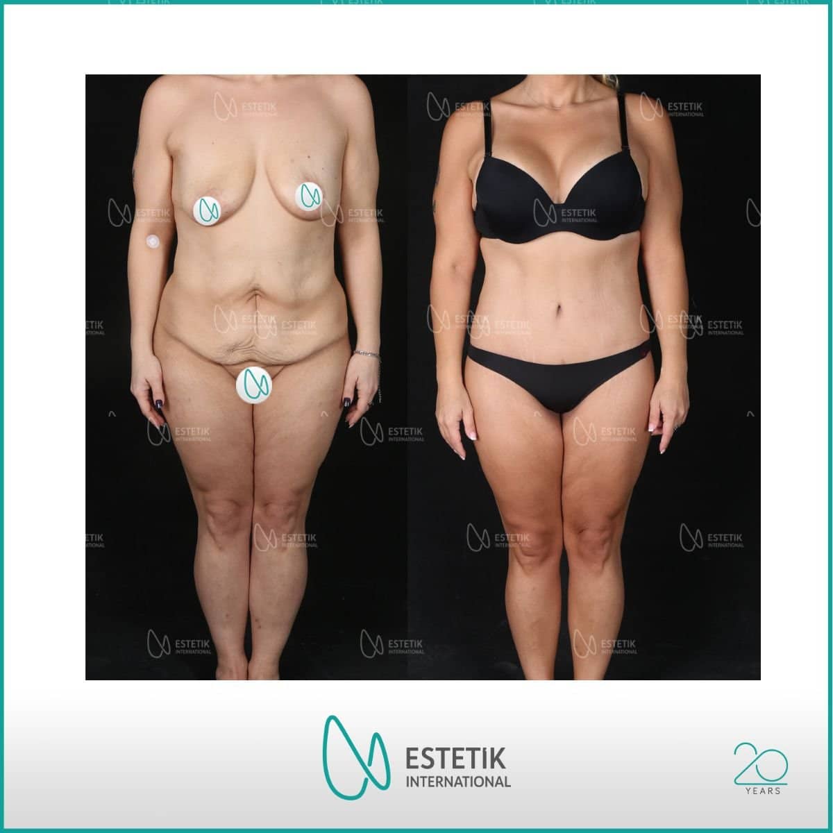 Case 19930 - abdominal liposuction