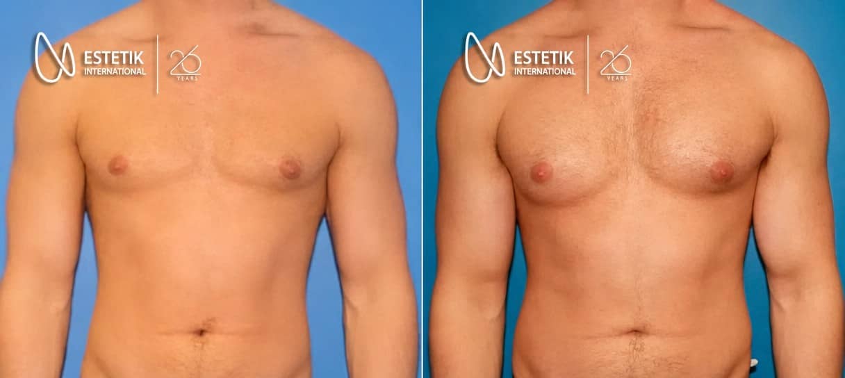 Case 19932 - pectoral implants