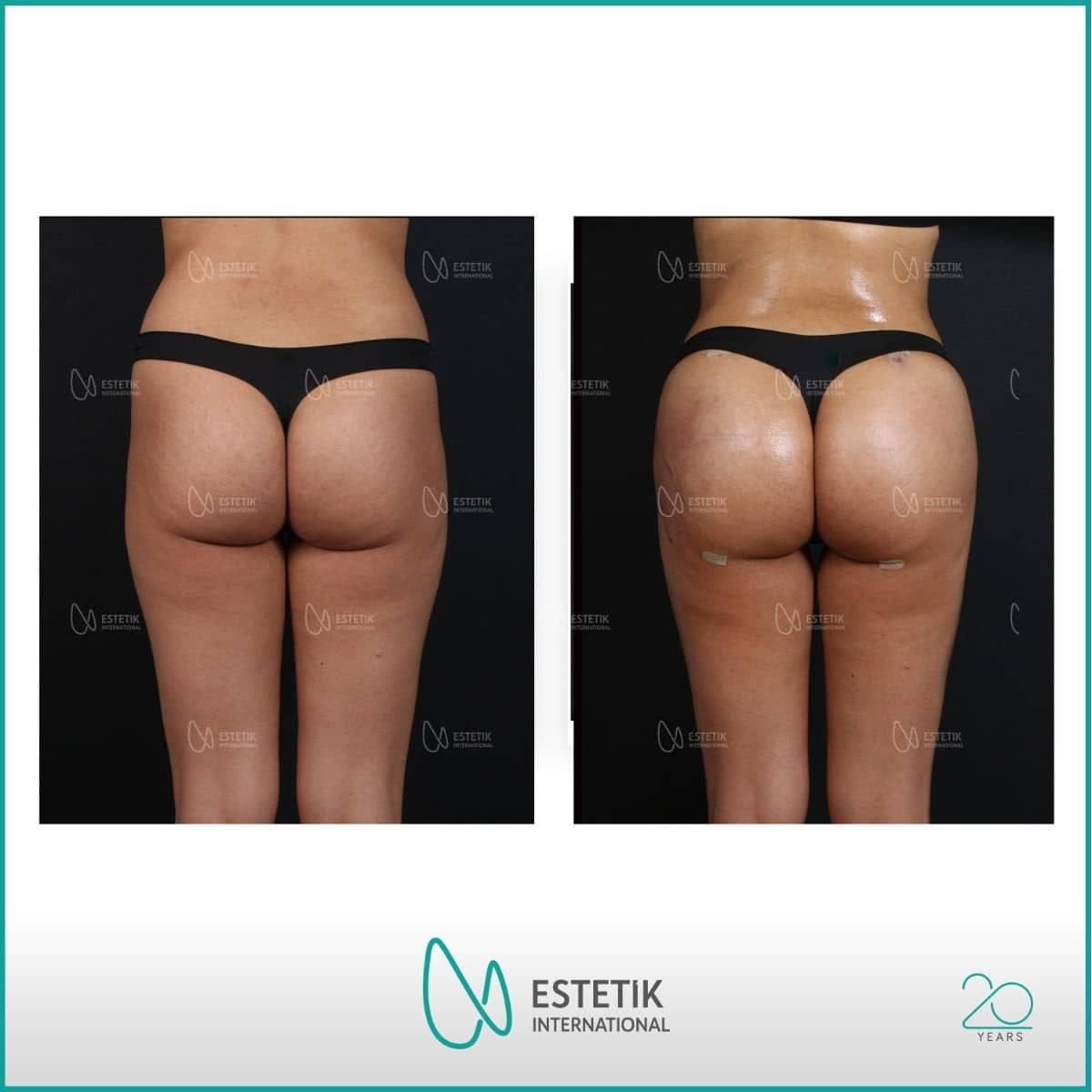 Case 19934 - Brazilian Butt Lift