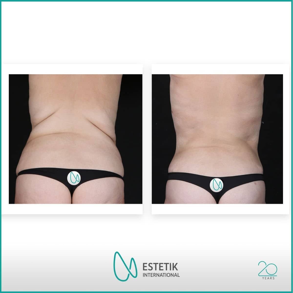 Case 19935 - tummy tuck and liposuction