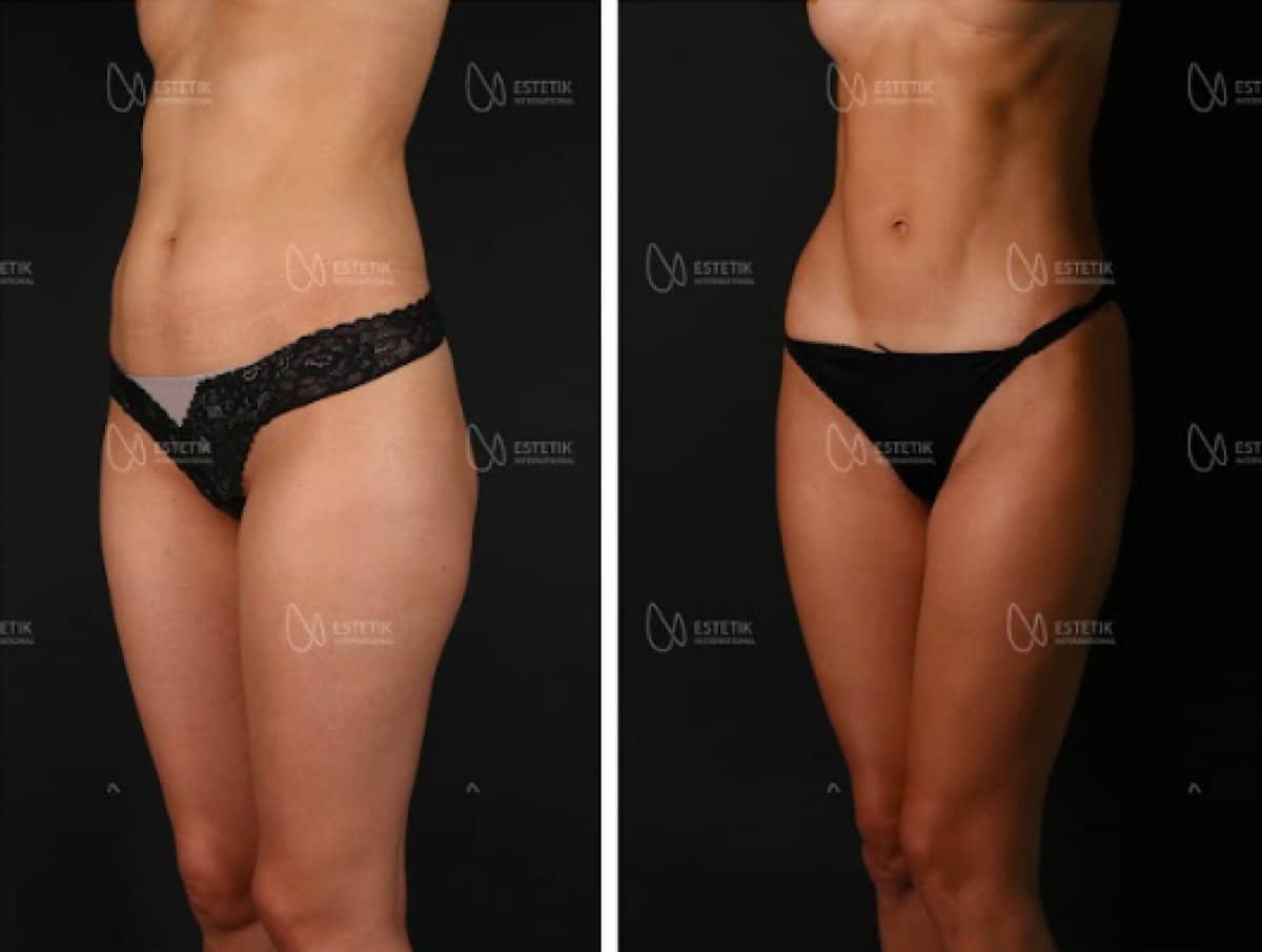 Case 19936 - abdominal liposuction