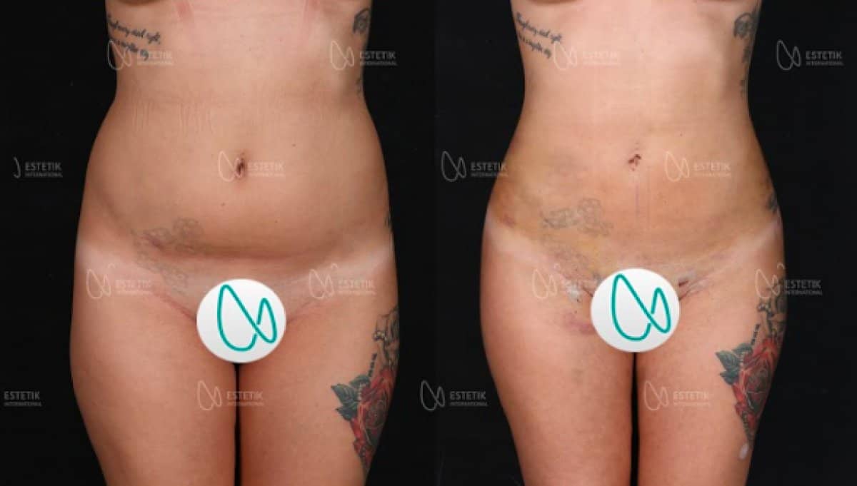 Case 19937 - abdominal liposuction