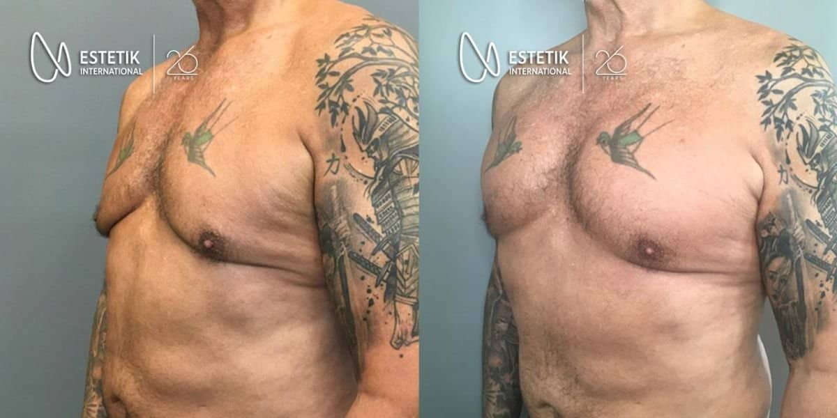 Case 19942 - pectoral implants