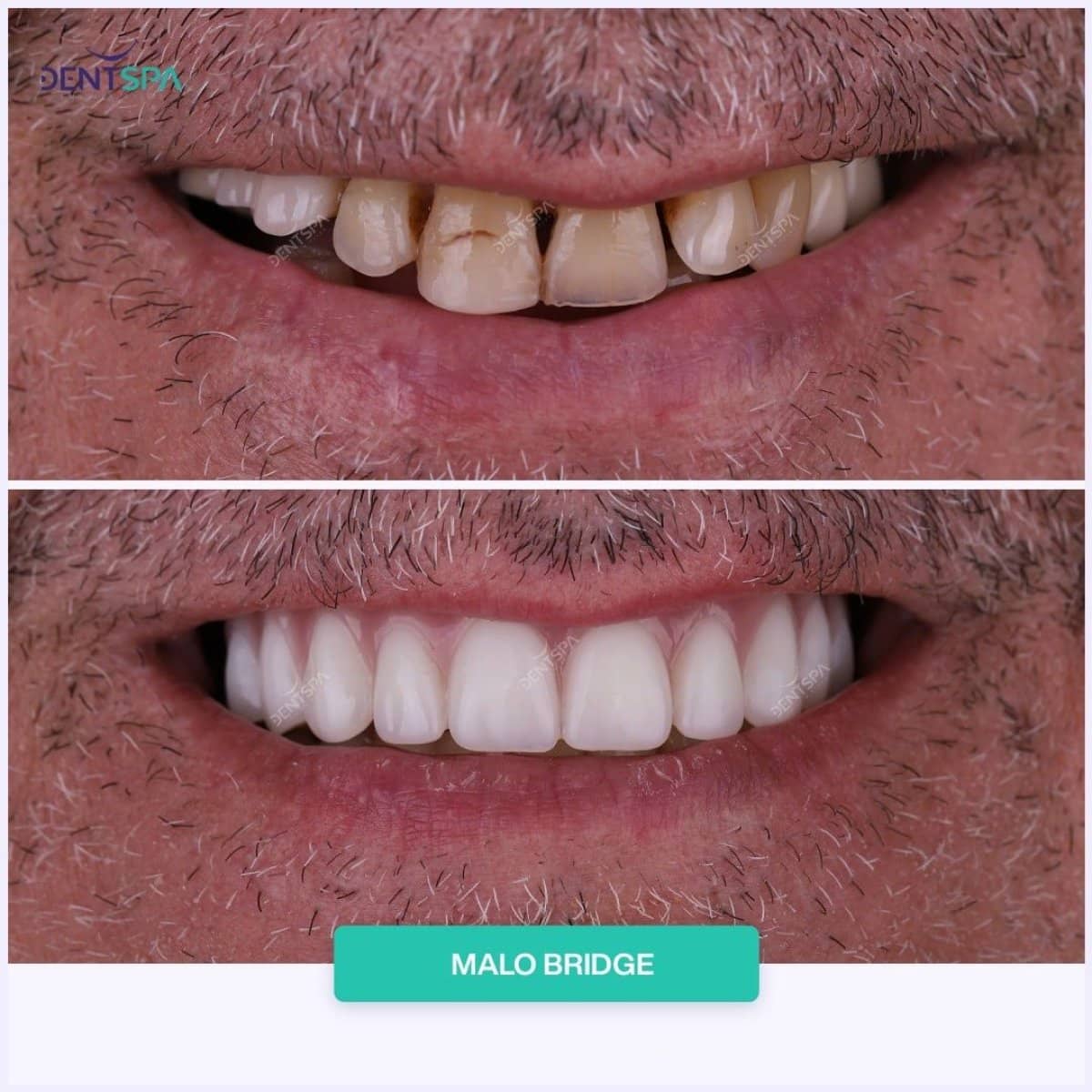 Case 19974 - Malo Bridge dental restoration