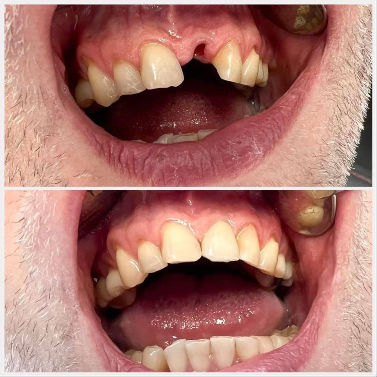 Case 19987 - mini dental implant