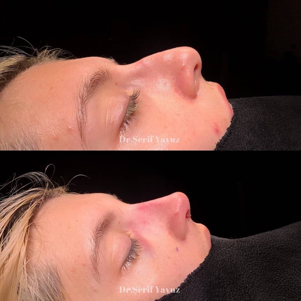 Case 19996 - rhinoplasty