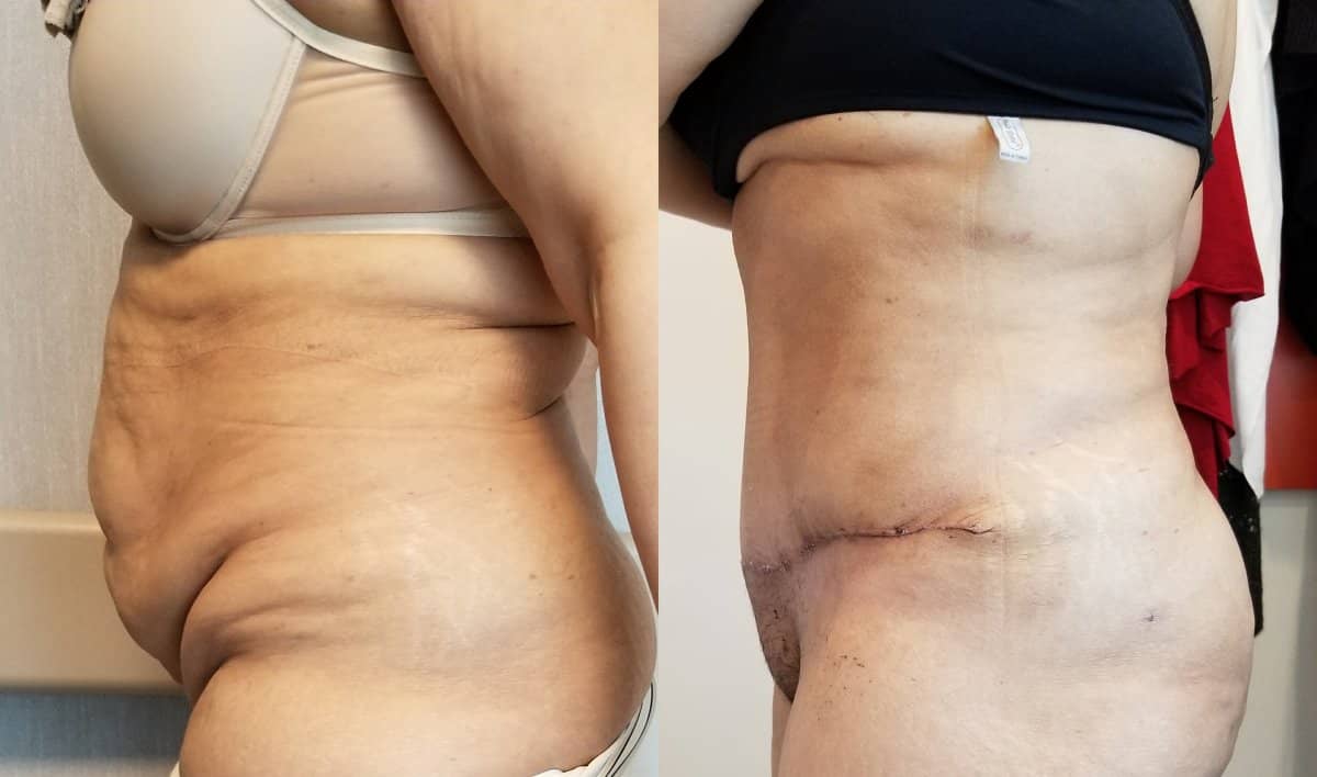 Case 19997 - tummy tuck
