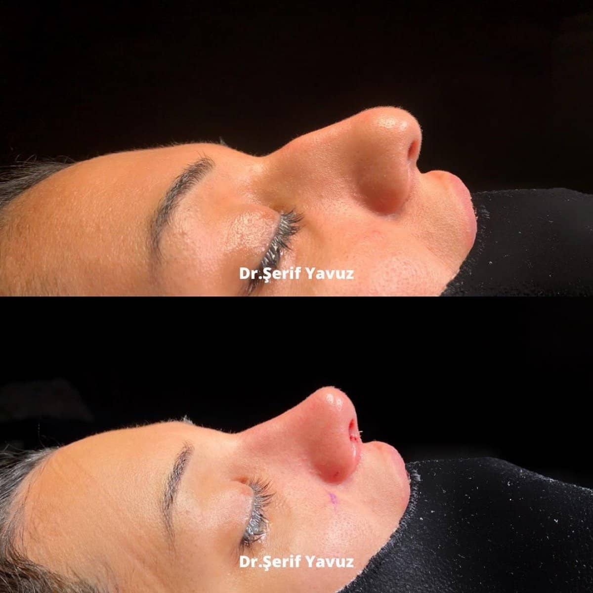 Case 19998 - rhinoplasty