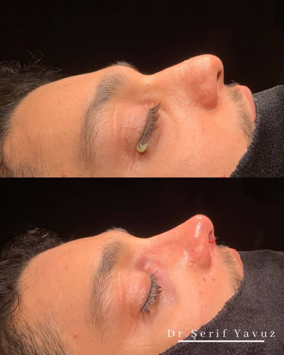 Case 19999 - rhinoplasty
