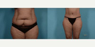 Case 200 - Woman treated with Tummy Tuck