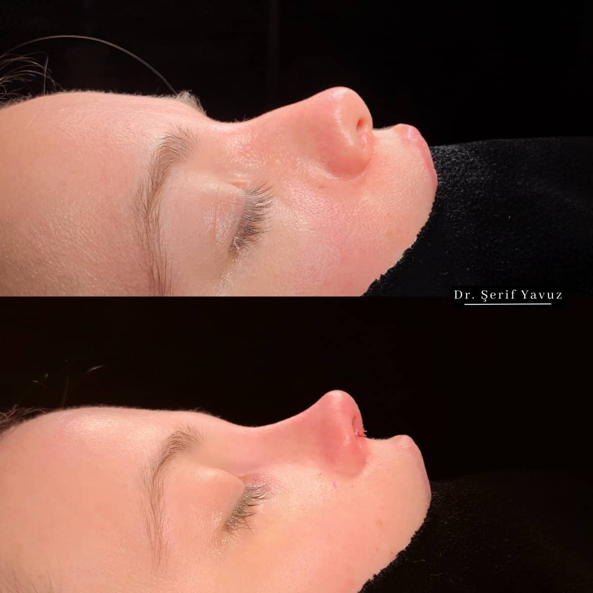 Case 20002 - rhinoplasty