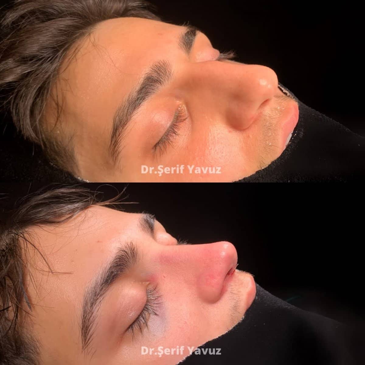 Case 20003 - rhinoplasty