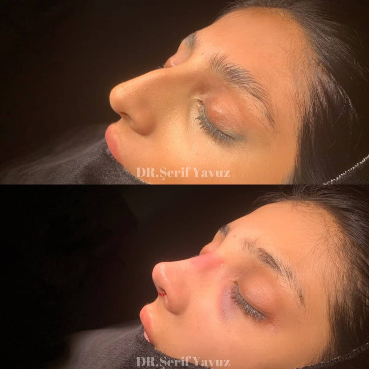 Case 20004 - rhinoplasty