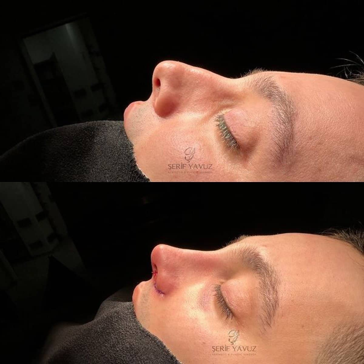 Case 20005 - rhinoplasty