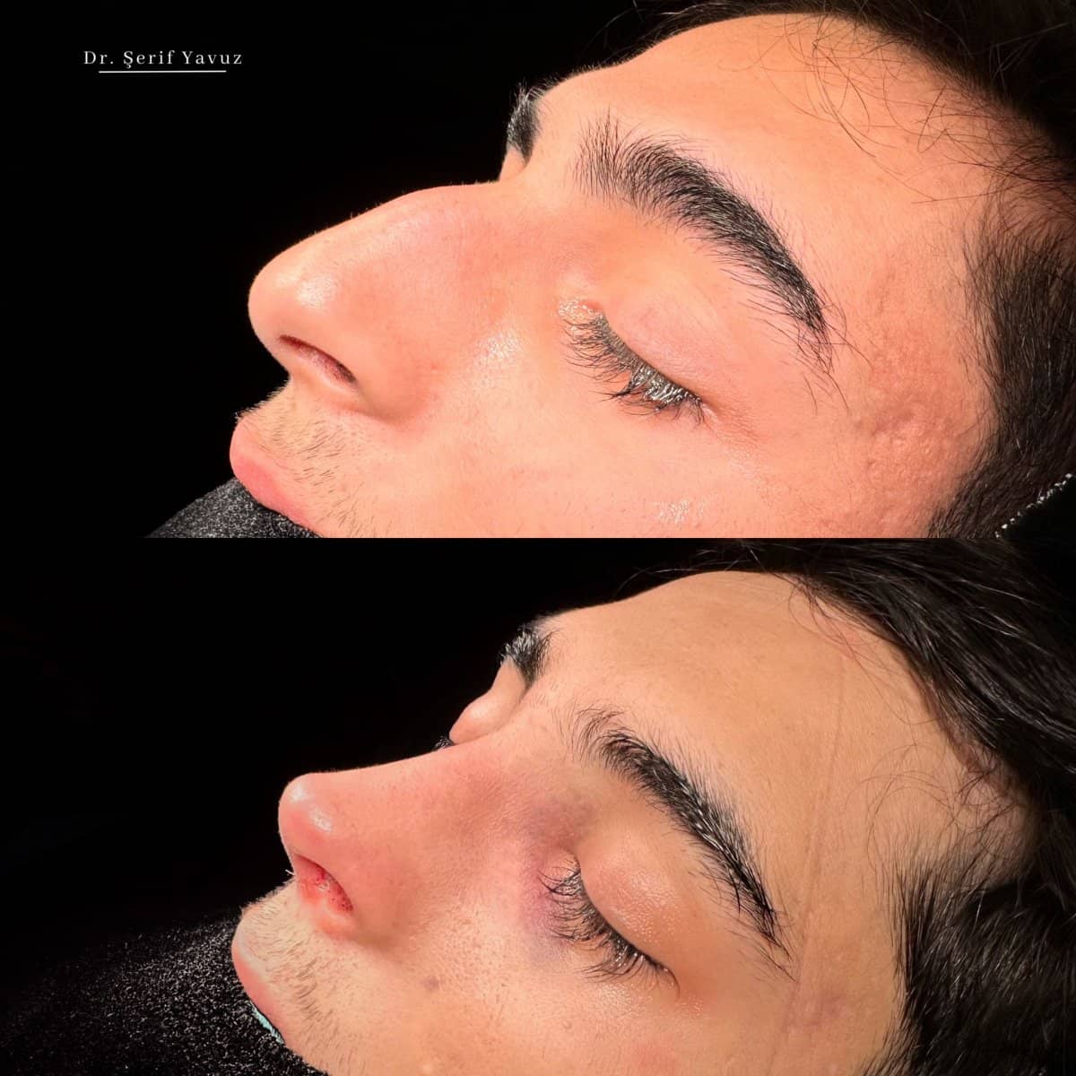 Case 20006 - rhinoplasty