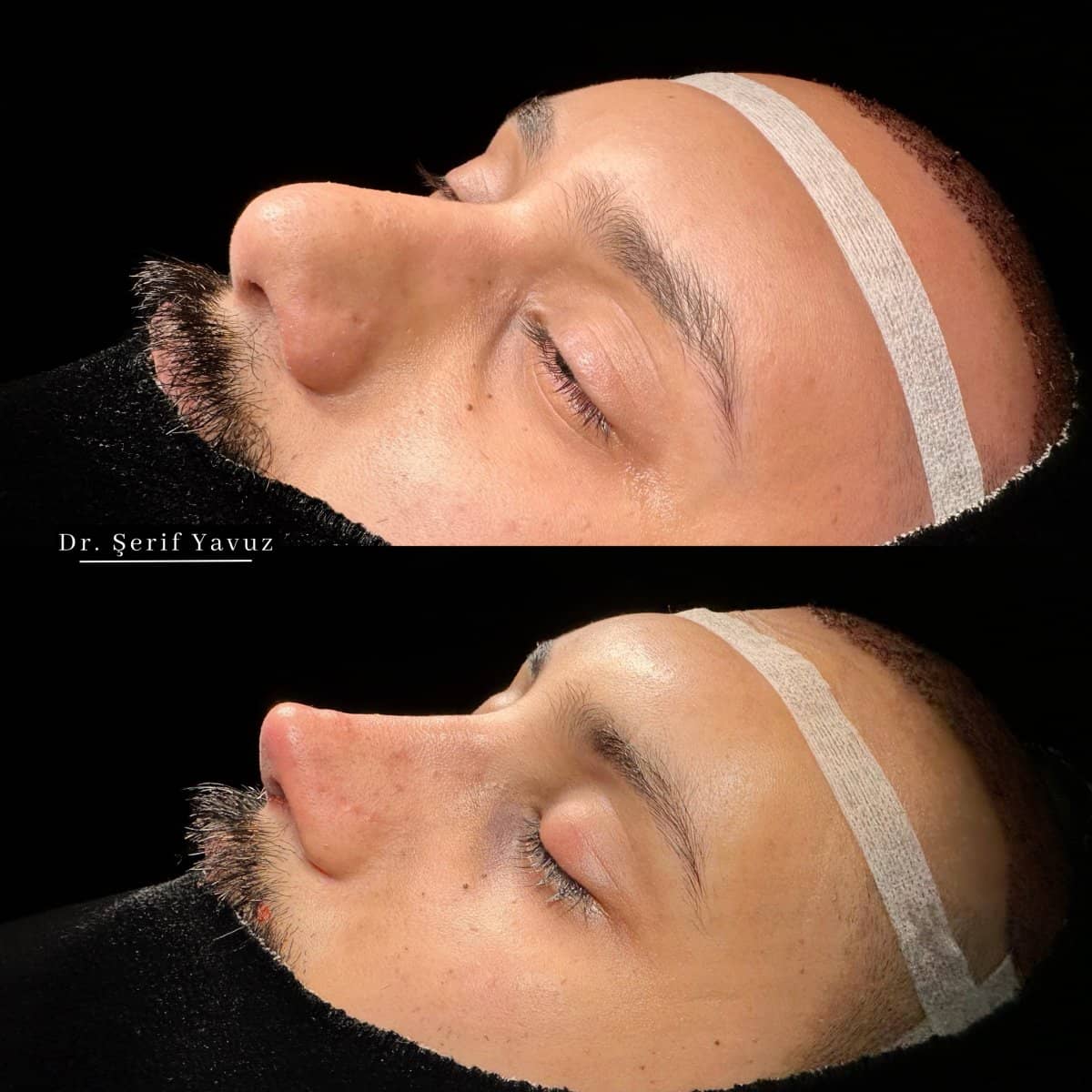 Case 20007 - rhinoplasty