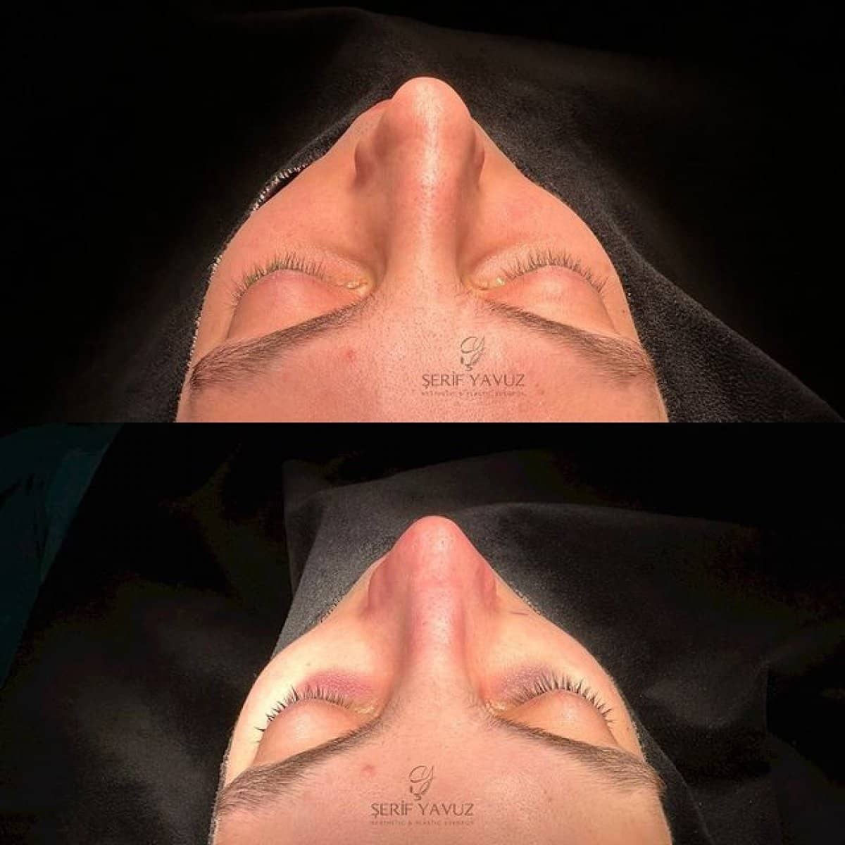 Case 20008 - rhinoplasty