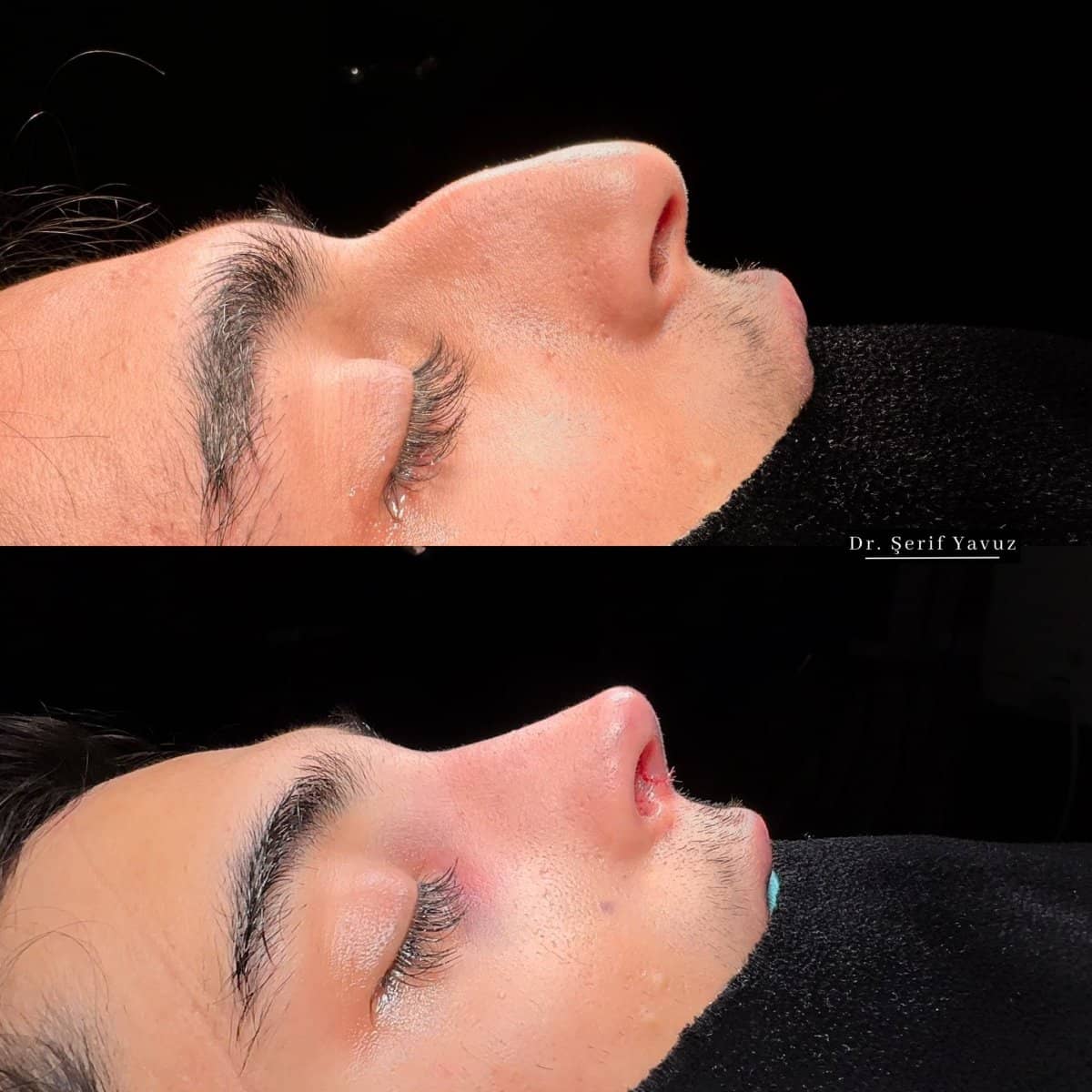 Case 20010 - rhinoplasty